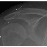 Gout in Shoulder X-ray image